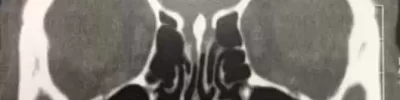 c-users-caio-desktop-otorrinolaringologia-fistula.jpeg.webp